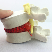 VERTEBRA08 (12392) Medizinisches Demo-Modell des lumbalen Bandscheibenvorfalls, 1,5-fach, Pathologisches Modell für die Patientenkommunikation